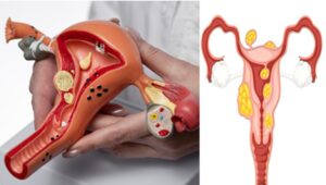 Αυτοθεραπεία από ινομυώματα και την αιμοραγία που προκαλούν, καθώς μετουσίωση συναισθηματικού βάρους σε χαρά ξεμπλοκάροντας τον μεσημβρινό  της σπλήνας πάγκρεας και λεπτού εντέρου 1