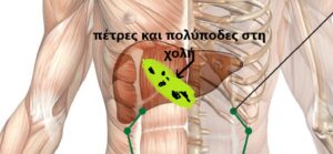 Αυτοθεραπεία από Πολύποδα στη χολή, πέτρες στα νεφρά και πολύποδες στη μήτρα. 1 Αυτοθεραπεία από Πολύποδα στη χολή, πέτρες στα νεφρά και πολύποδες στη μήτρα. 1