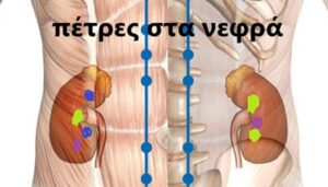 Αυτοθεραπεία από Πολύποδα στη χολή, πέτρες στα νεφρά και πολύποδες στη μήτρα. 3 Αυτοθεραπεία από Πολύποδα στη χολή, πέτρες στα νεφρά και πολύποδες στη μήτρα. 3