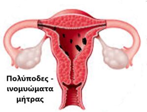Αυτοθεραπεία από Πολύποδα στη χολή, πέτρες στα νεφρά και πολύποδες στη μήτρα. 2 Αυτοθεραπεία από Πολύποδα στη χολή, πέτρες στα νεφρά και πολύποδες στη μήτρα. 2